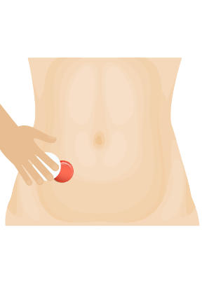 como-se-coloca-una-galleta-bolsa-colostomia-ileostomia-eii-2