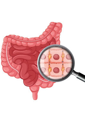 porque-se-produce-enfermedad-de-crohn-1